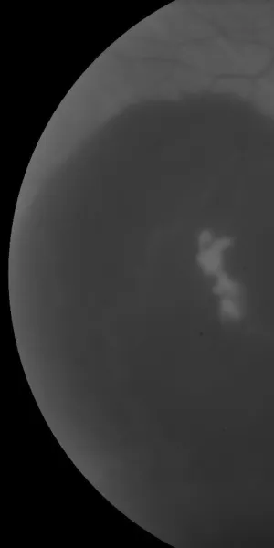 Image of eye with wet macular degeneration