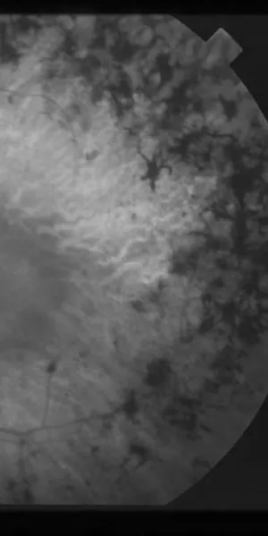 Image of eye with retinitis pigmentosa