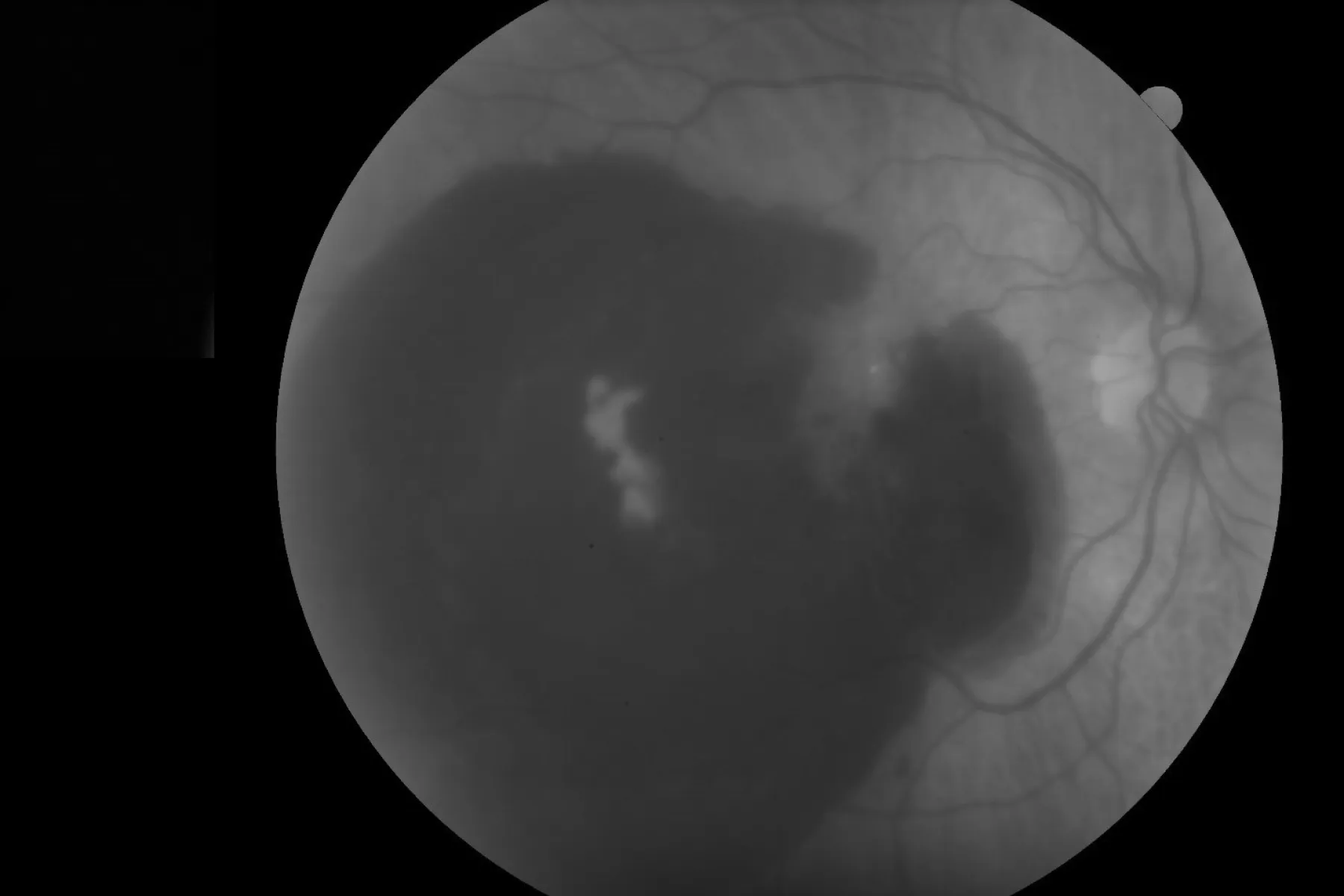 Image of eye with wet macular degeneration
