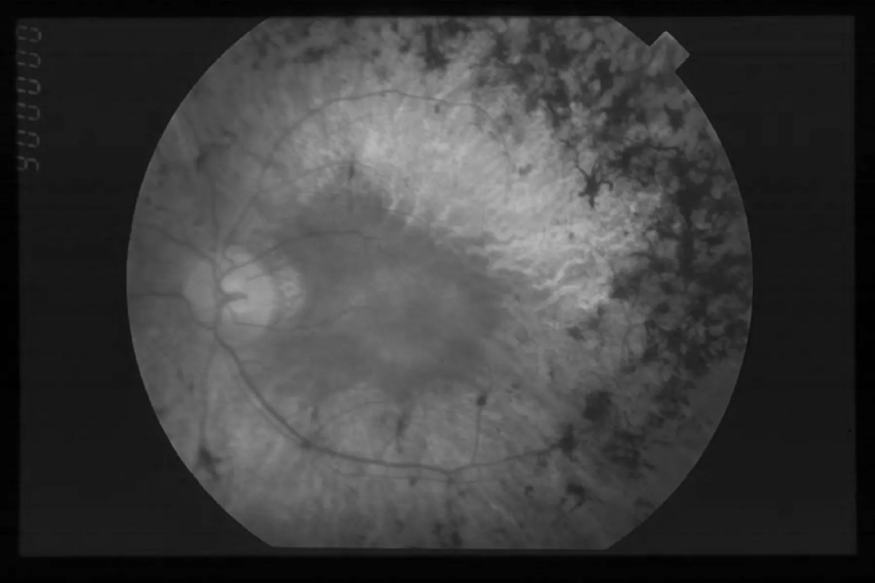 Image of eye with retinitis pigmentosa