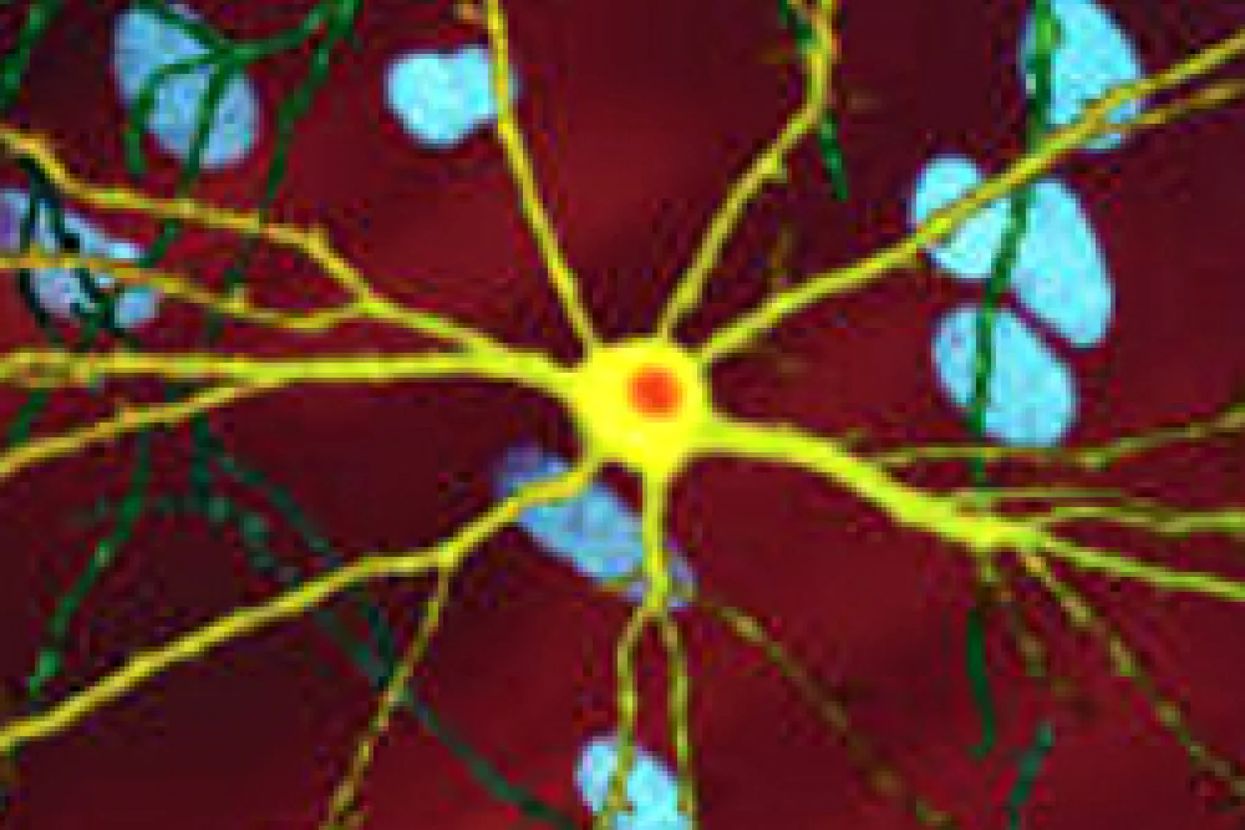 Neuron_with_mHTT_inclusion_zoomed