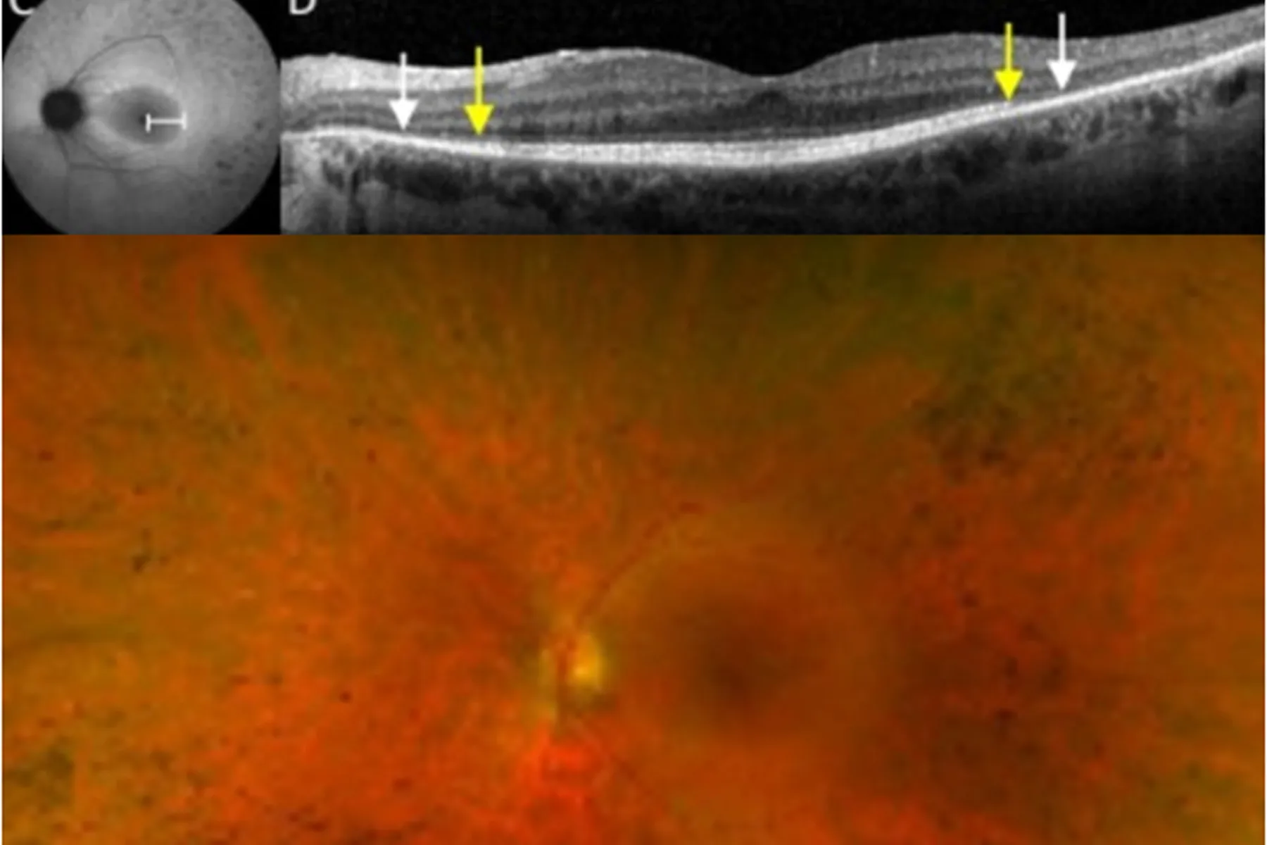  Retinal imaging in a control eye (A, B) and a patient with RPGR -/y dystrophy (C, D).