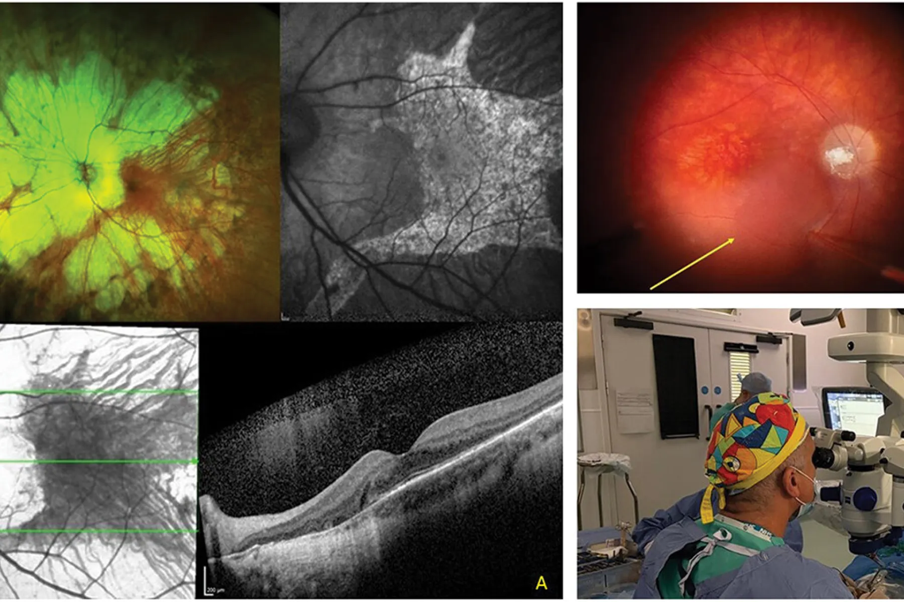 Multimodal retinal imaging of a patient with choroideremia