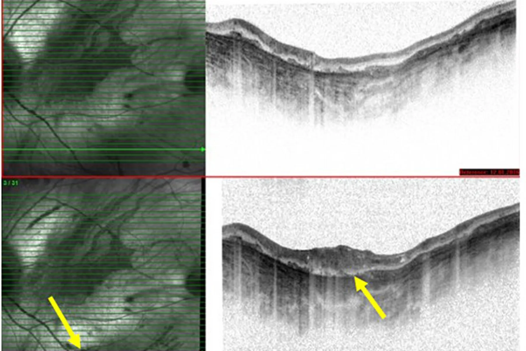 Infra red (IR) and OCT scans before and after AAV2.CAG.REP1 gene therapy